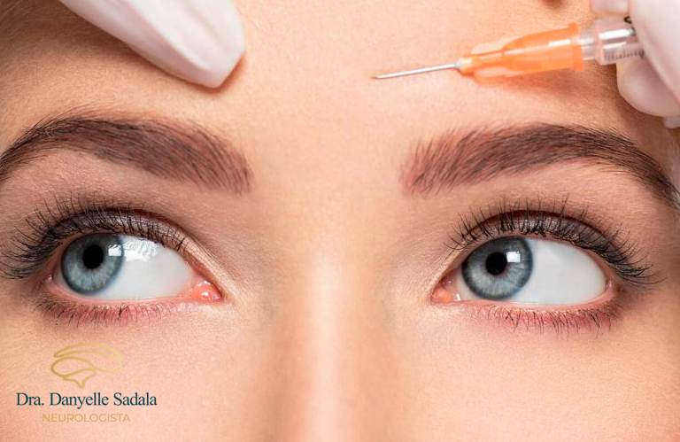 Quais são os pontos de aplicação do Botox para enxaqueca e por que são importantes?